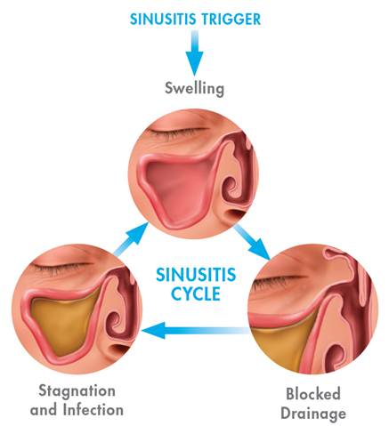 clogged sinuses headache