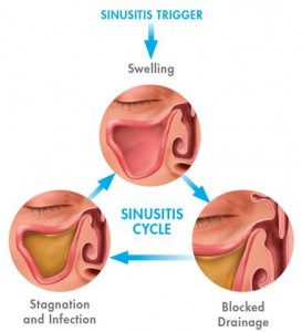 sinusitis-trigger